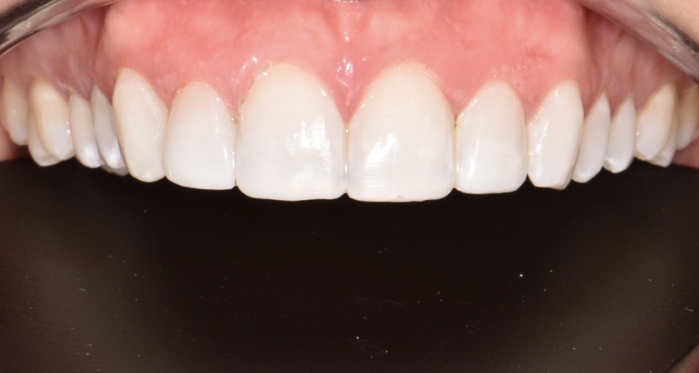 teeth whitening results