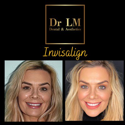 abc principle invisalign orlaith