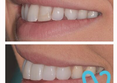 Affordable composite veneers belfast