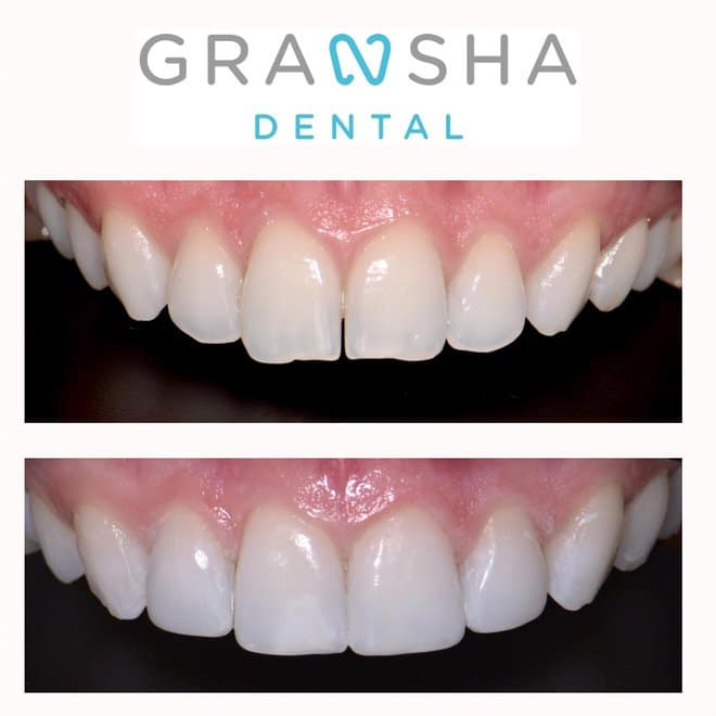 Before and after teeth straightening results at Gransha Dental