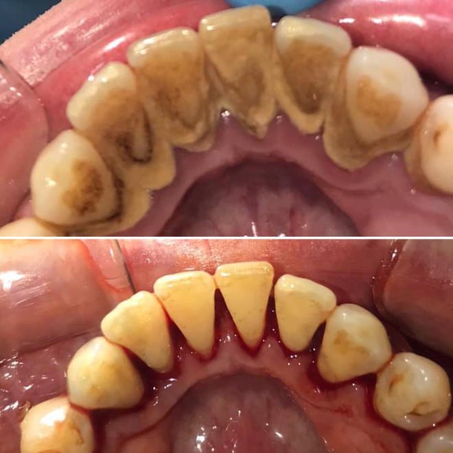 Before photos showing tartar and staining on upper and lower teeth prior to hygienist treatment