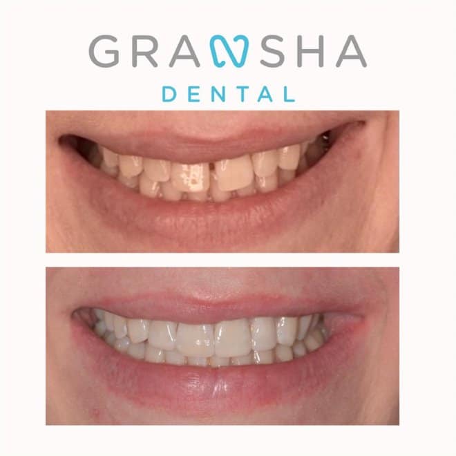 Before and after crowded front teeth correction