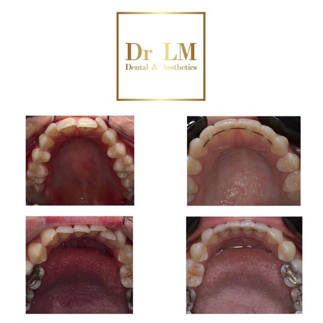 Before and after dental alignment photos by Dr LM Dental & Aesthetics