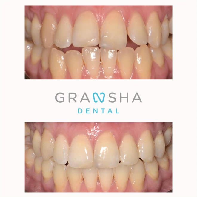 Before and after front teeth straightening results