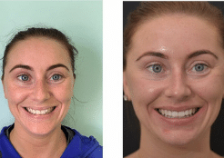 Patient before and after photos showing improved smile