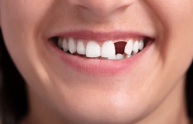 Close-up of a smile with a visibly missing front tooth