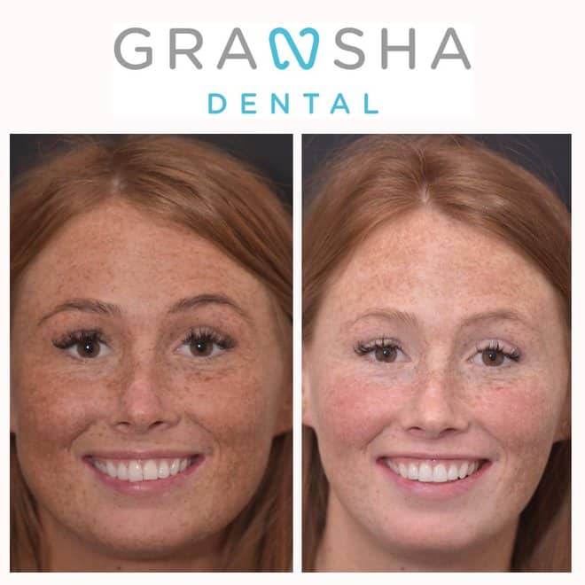 Patient before and after Invisalign treatment at Gransha Dental