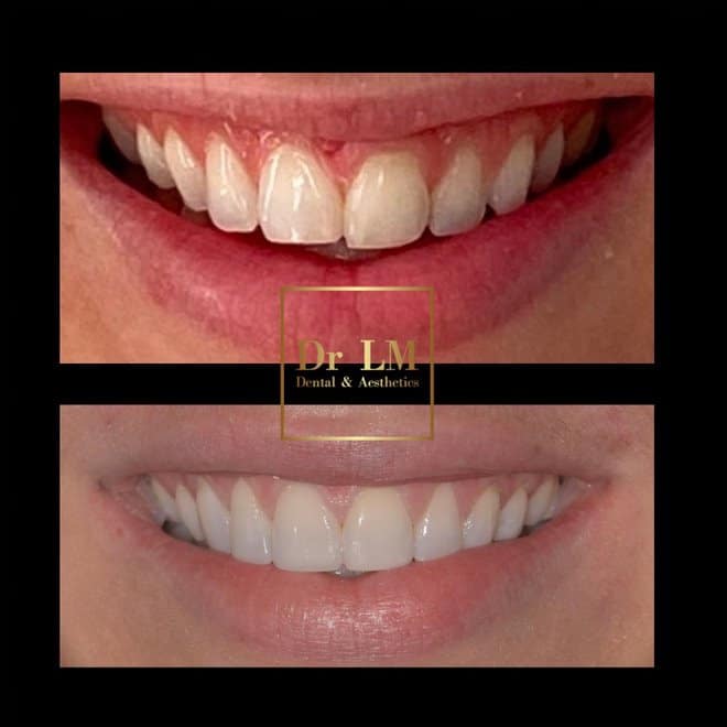 Before and after closing a front tooth gap with composite bonding