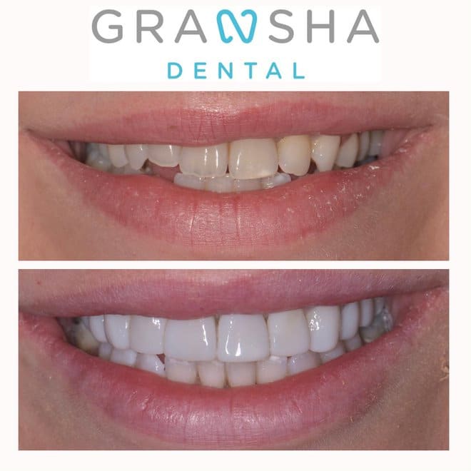 Before and after composite bonding showing whiter, more even smile