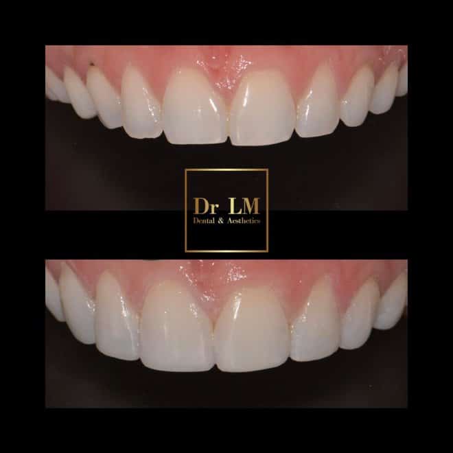 Before and after composite bonding on upper front teeth