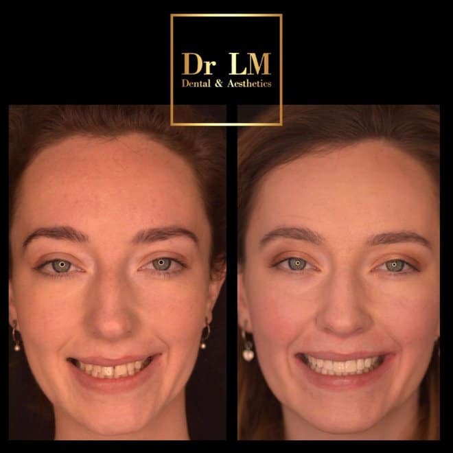 Patient before and after full smile transformation