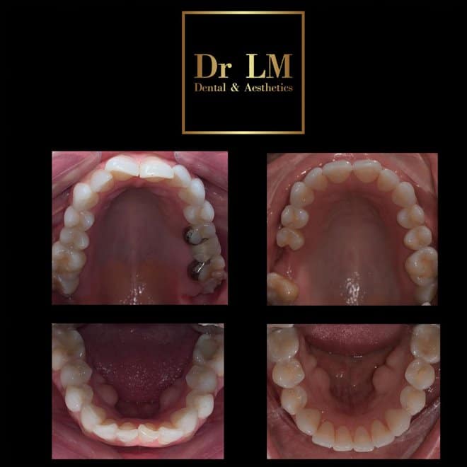 Before and after overhead views of upper and lower teeth alignment