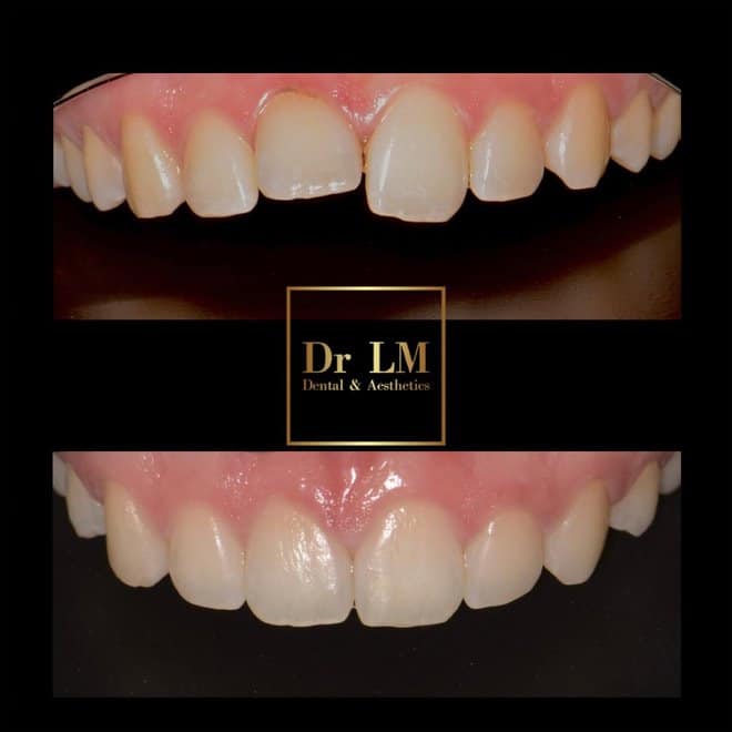 Before and after teeth straightening close-up by Dr LM Dental & Aesthetics