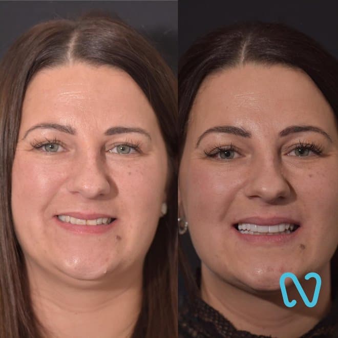 Patient before and after composite veneer smile transformation