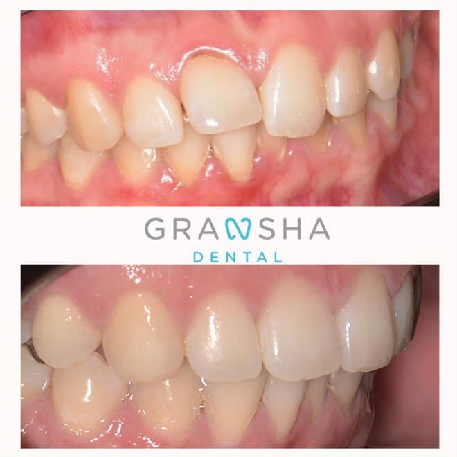 Before and after crowded teeth correction at Gransha Dental