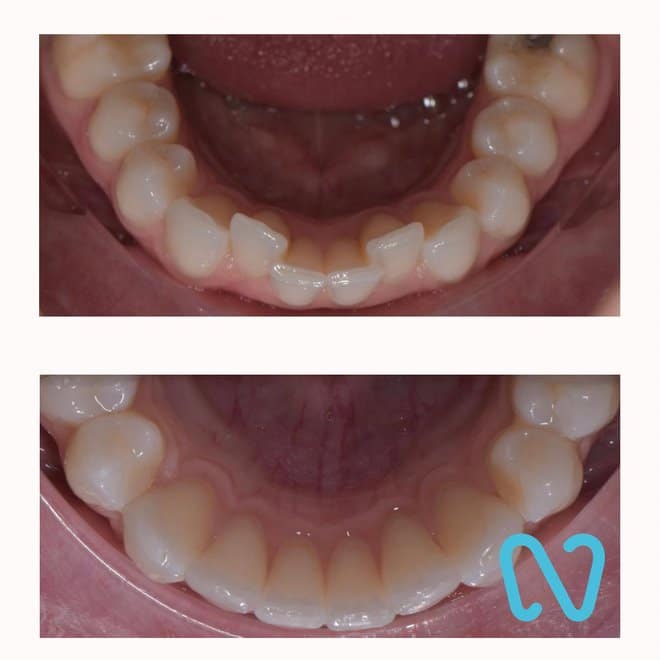 Before and after lower teeth alignment