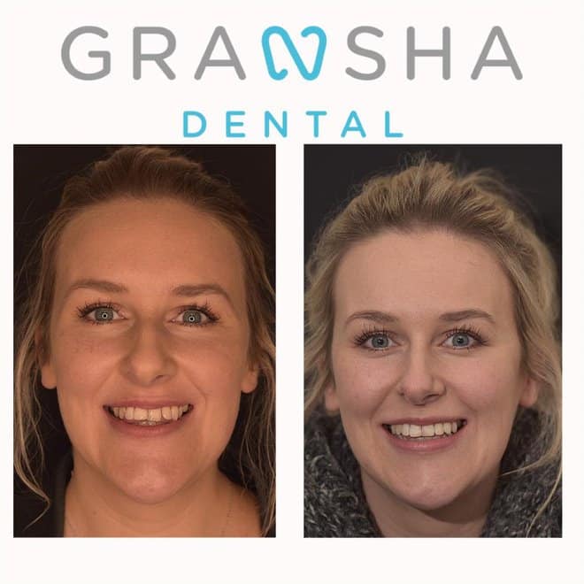 Patient before and after smile improvement results