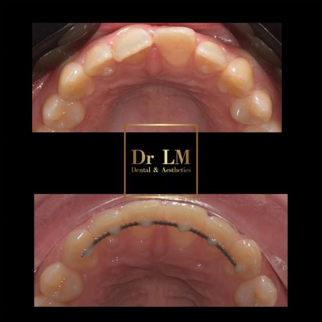 Before and after upper teeth alignment by Dr LM Dental & Aesthetics