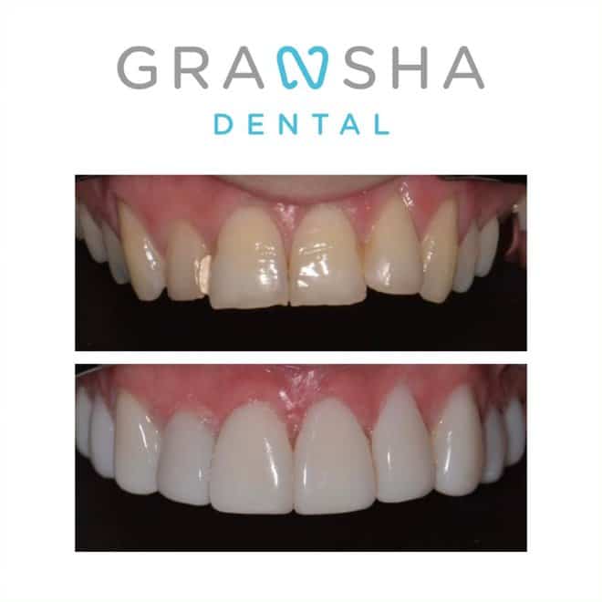 Before and after teeth straightening results