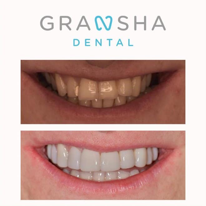 Before and after teeth whitening and straightening results