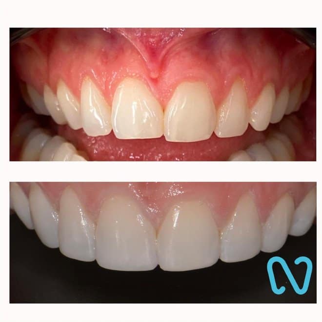 Before and after gum and teeth alignment treatment