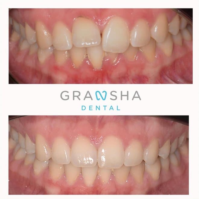 Before and after teeth straightening results