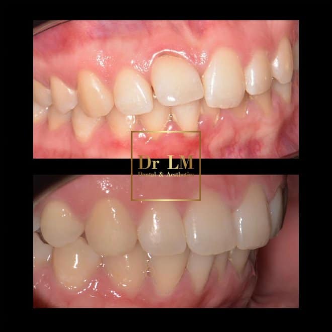 Before and after side-view teeth alignment results