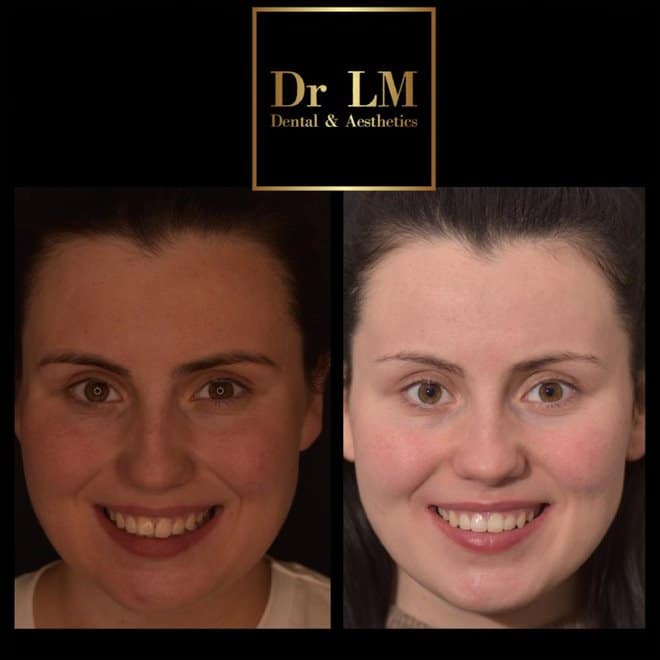 Patient before and after Invisalign smile transformation