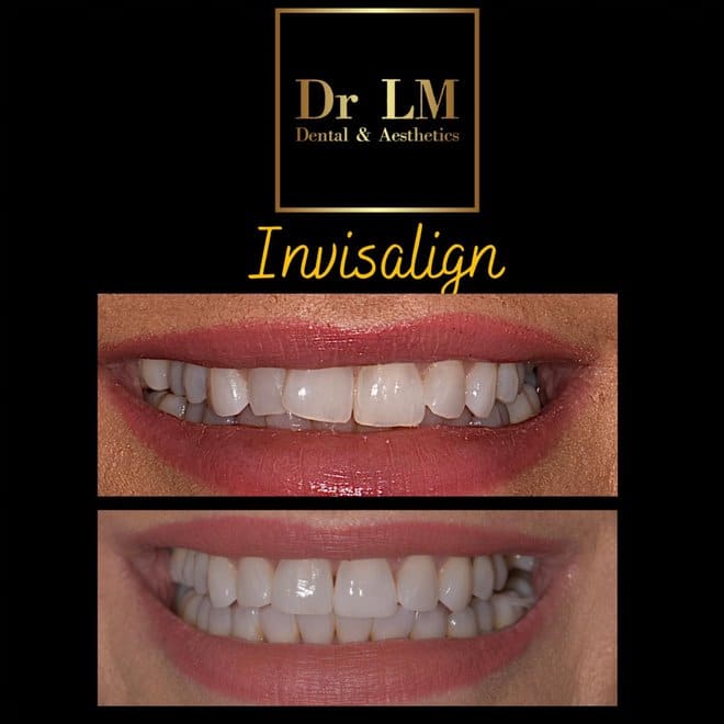 Before and after Invisalign treatment showing straighter, more even smile