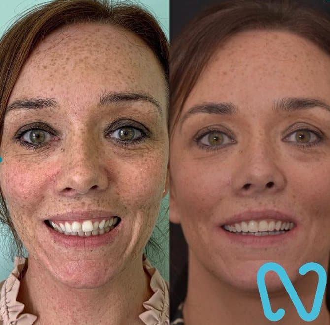 Patient before and after smile makeover showing improved tooth alignment and symmetry