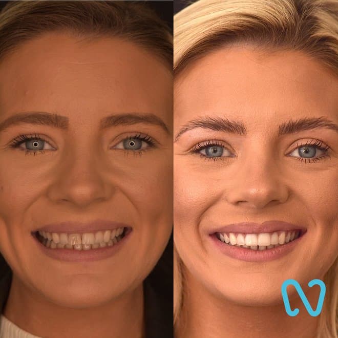 Patient before and after composite veneers showing a brighter, more even smile